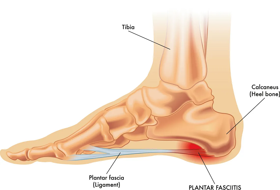¿Sufres de fascitis plantar? Conoce nuestro enfoque integral