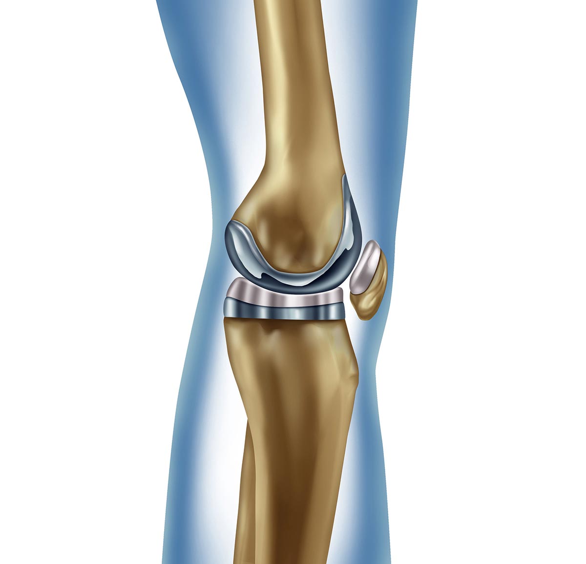 Medirval prótesis de rodilla