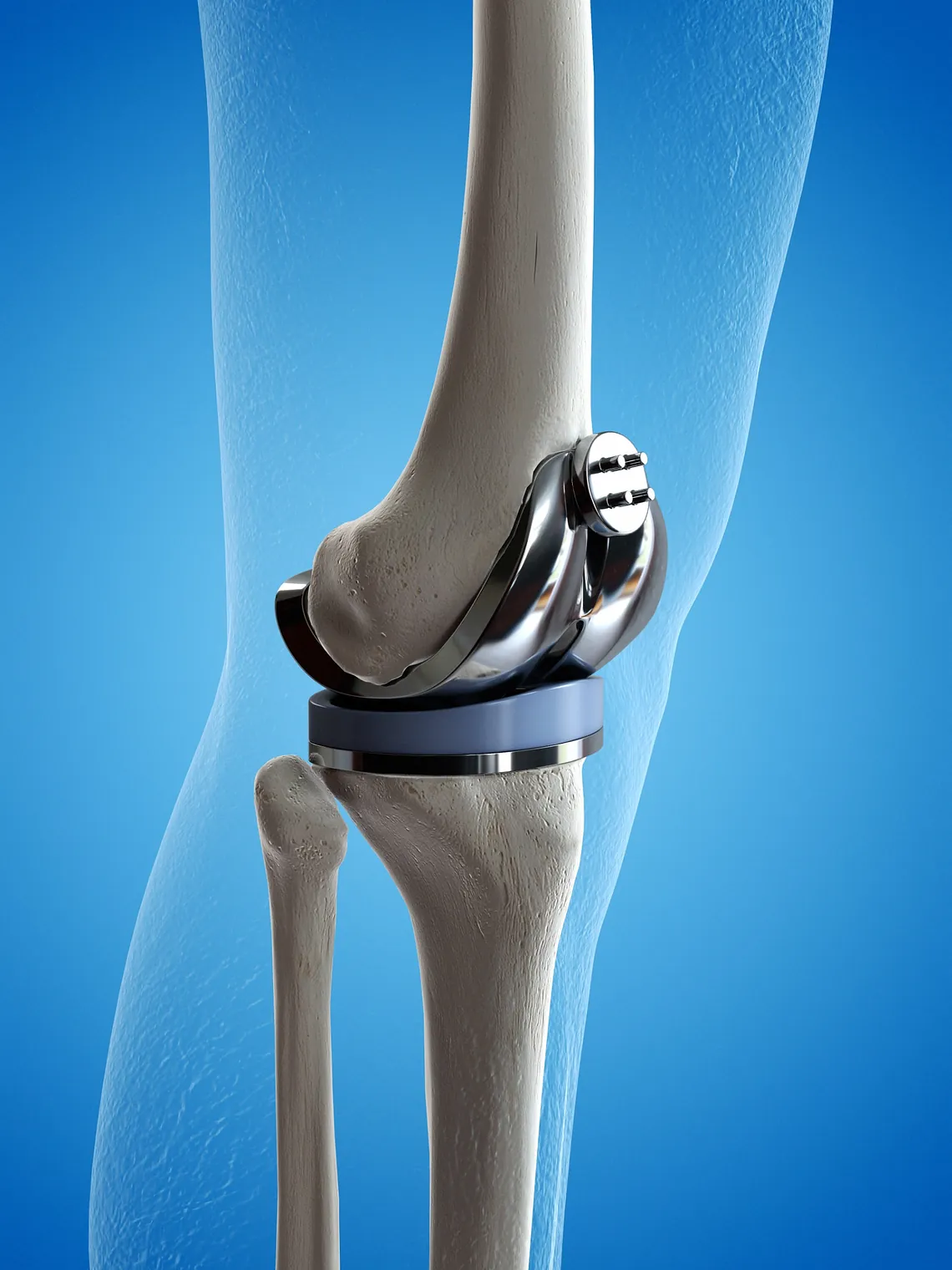 protesis rodilla