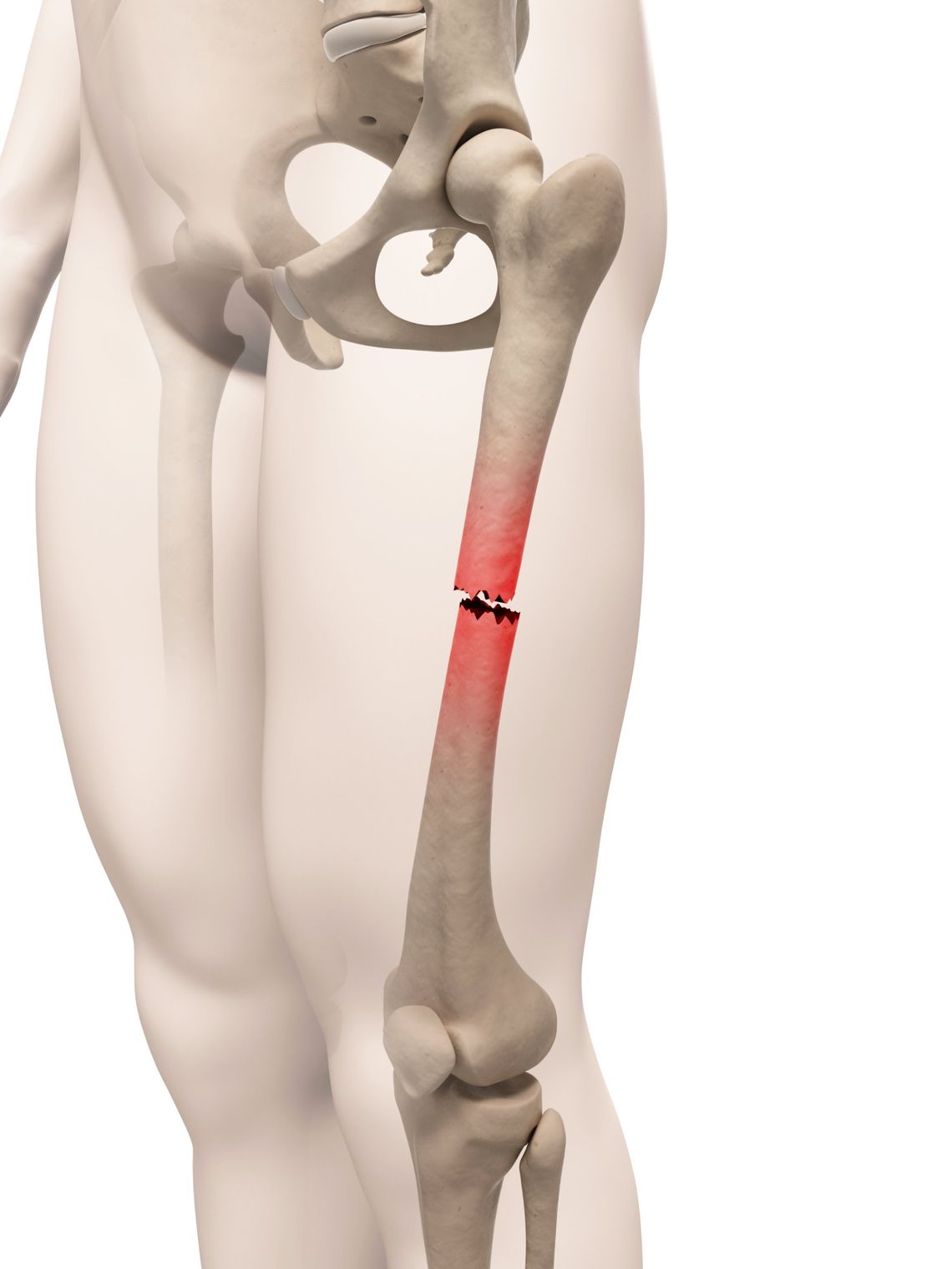 Fracturas por estrés. Síntomas, diagnóstico y tratamiento.