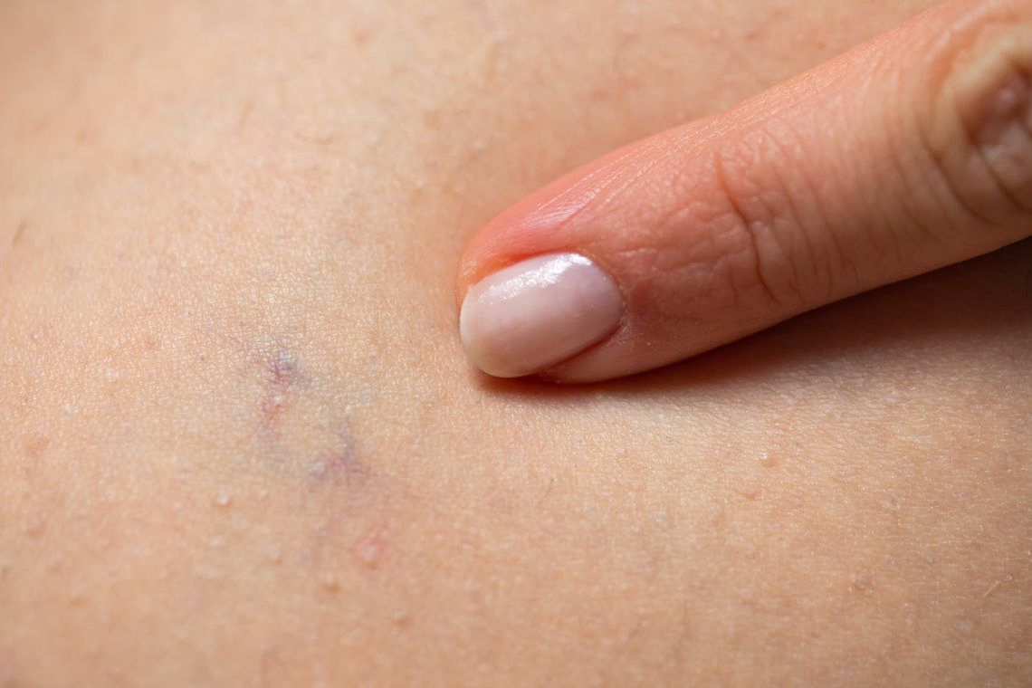 Tratamientos más comunes en cirugía vascular